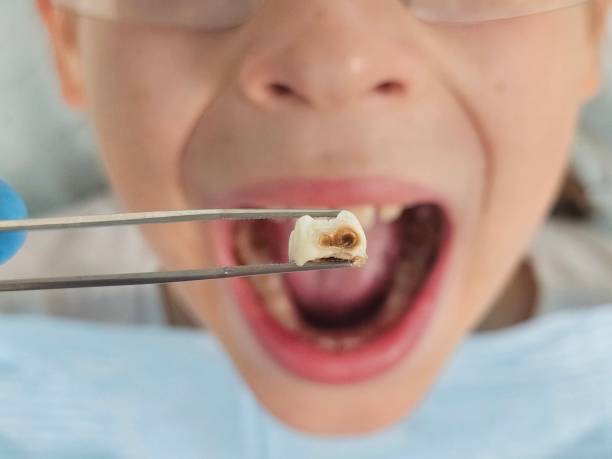 Best Emergency Dental Care for Broken or Chipped Teeth in Whiteman Af, MO